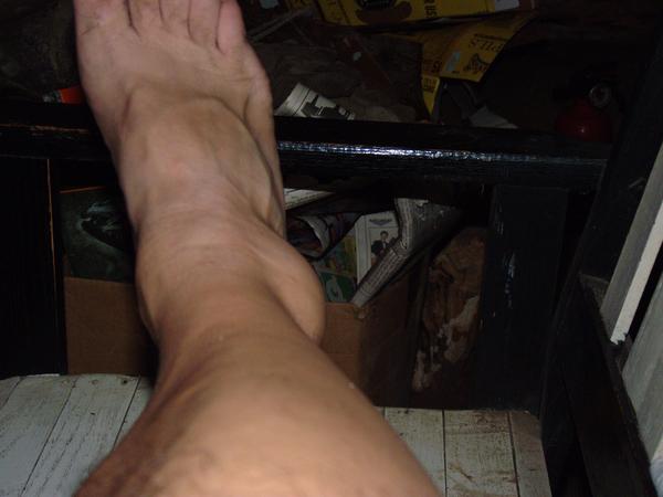 My ankle after hobbling back to the cabin.